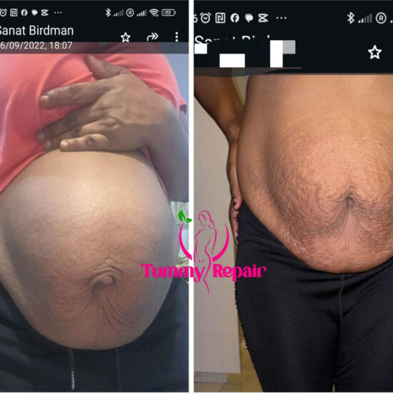 tummyrepair-before-and-after-postpartum-recovery-transformations (1)