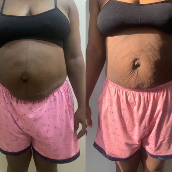 tummyrepair-before-and-after-postpartum-recovery-transformations (2)