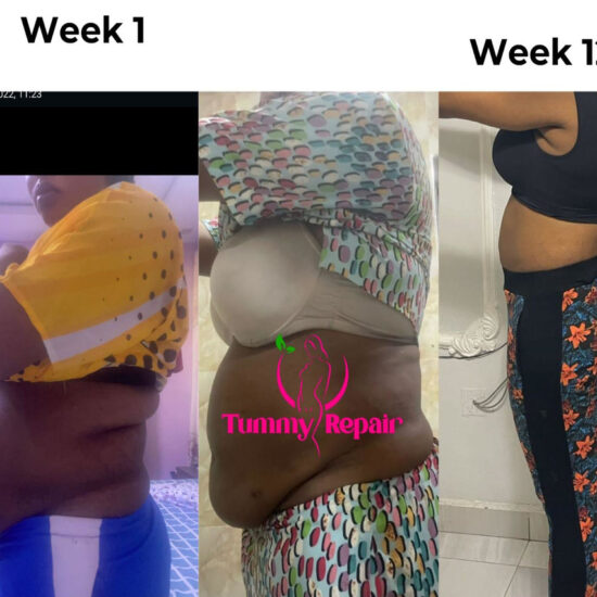 tummyrepair-before-and-after-postpartum-recovery-transformations (3)