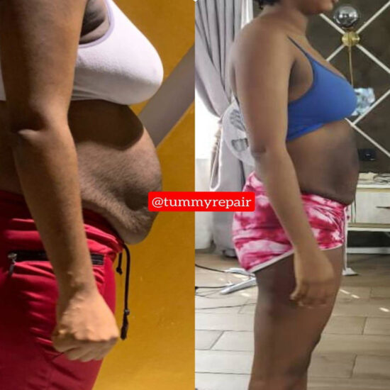 tummyrepair-before-and-after-postpartum-recovery-transformations (5)