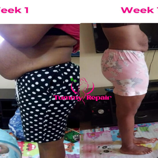 tummyrepair-before-and-after-postpartum-recovery-transformations (6)