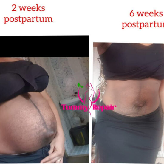 tummyrepair-before-and-after-postpartum-recovery-transformations (8)
